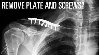 Should you have your plate and screws removed after your ankle fracture heals?