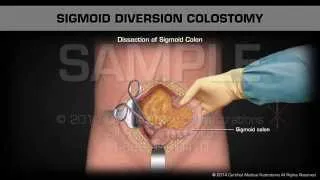 Sigmoid Diversion Colostomy
