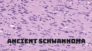 "Ancient" Schwannoma (with benign degenerative atypia/pleomorphism) pathology