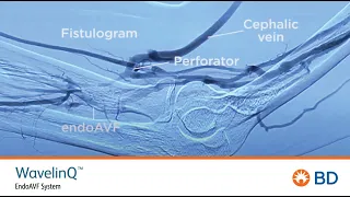 Outside U.S. only WavelinQ™ 4F EndoAVF Procedure - Ulnar/Ulnar Creation (No Audio)