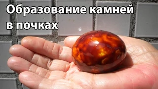 Образование камней в почках