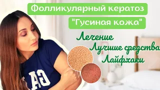 🦆ГУСИНАЯ КОЖА: Как избавиться?ФОЛЛИКУЛЯРНЫЙ ГИПЕРКЕРАТОЗ на руках, ногах,лице, попе: Фото, Лечение.