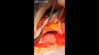DR A HAFEZ    SKIN TO SKIN CAESAREAN SECTION AND APPENDECTOMY