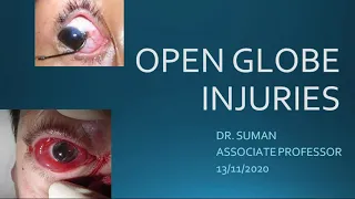 A Class On OpenGlobe Injuries By Dr Suman,Dept Of Ophthalmology
