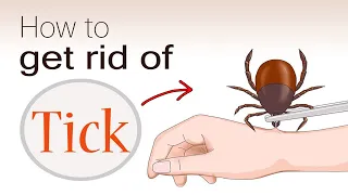 How to Remove Ticks from your Skin without Pain || Home Remedies for Ticks Removal