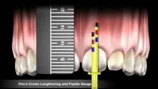 Chu's Crown Lengthening Gauge