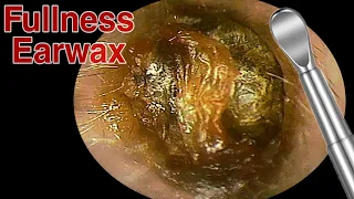 BIGGEST Ear Wax, Difficult Removal - EP3 | Doctor Anh