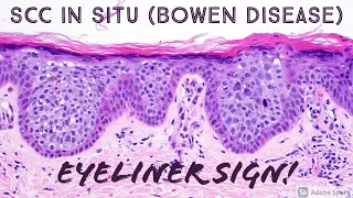 "Eyeliner Sign" (best ever!) in squamous cell carcinoma in situ/Bowen disease (dermpath dermatology)