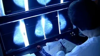 New draft guidance drops breast cancer screening age to 40