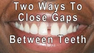 How to Close Gaps Between Teeth