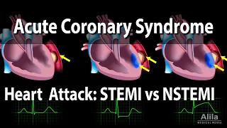 Acute Coronary Syndrome: Unstable Angina, NSTEMI and STEMI (Heart Attack), Animation