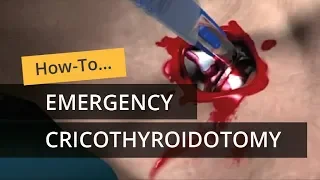 Emergency Cricothyroidotomy using CricKey