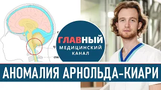 Симптомы Аномалии Арнольда-Киари. Синдром Арнольда Киари 1-2 типа/степени. Эктопия миндалин мозжечка