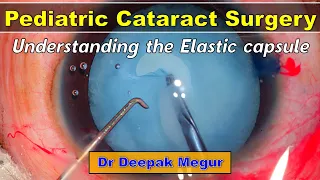 The Elastic Anterior Capsule in Children: Pediatric Cataract Surgery : Dr Deepak Megur
