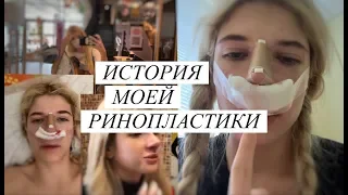 СДЕЛАЛА РИНОПЛАСТИКУ В 17 // ЧТО СКАЗАЛИ МОИ РОДИТЕЛИ ?? // НАЧАЛИСЬ ОСЛОЖНЕНИЯ ...