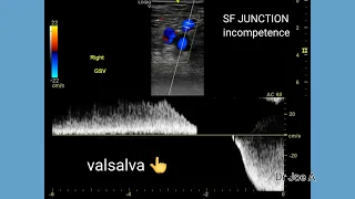 Sapheno-femoral junction incompetence, varicose veins, color and spectral Doppler ultrasound video