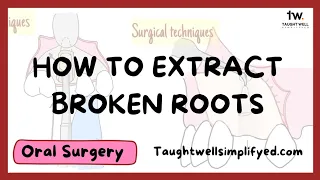 4 ways to extract broken root tips and when to LEAVE THEM ALONE @mentaldental @DentalDigest