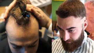 KRASSE Veränderung NACH seiner Bart- und Haartransplantation