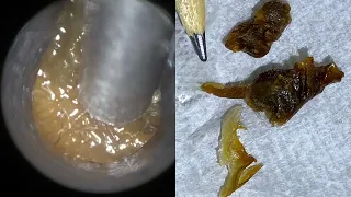 76 - Two Huge Ear Wax Plugs Removed using the WAXscope®️