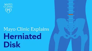 Mayo Clinic Explains Herniated Disk
