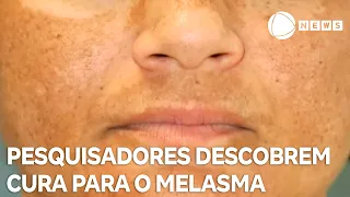 Pesquisadores descobrem cura para o melasma