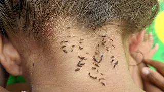 Pick out a lot of lice from short hair - Remove thousand lice from head