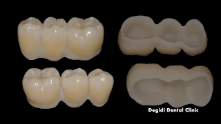 Weld-on-4 case with 3 concepts: WeldOne, Conometric and Cerec.