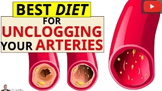 » Best Diet For Removing Calcium Deposits & Plaque Buildup From Your Blocked Arteries