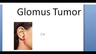 ENT Glomus Tumor Jugulare Tympanicum Ear Middle Bodies Rising Sun Brown Sign Pulsating Treatment