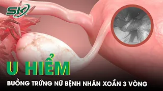 Đi Khám Vì Đau Bụng, Bệnh Nhân Nữ Phát Hiện U Nang Buồng Trứng Xoắn 3 Vòng | SKĐS