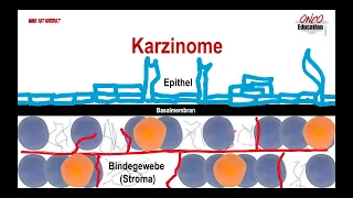 Types of cancer - carcinomas, sarcomas etc.