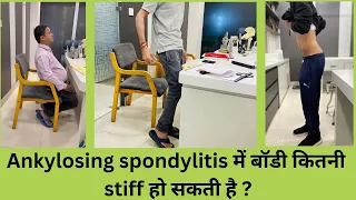 How stiff body can get in Ankylosing spondylitis?