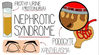 Nephrotic Syndrome Explained Clearly