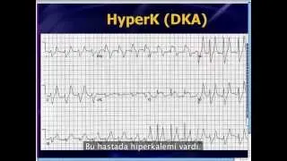 Mattu EKG Vakası: Impressive Syndrome - 20 Mayıs 13 Türkçe Altyazılı - Acilci.Net