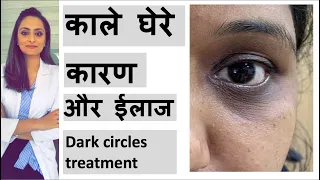 डार्क सर्कल का ईलाज | आखो के काले घेरे के कारण | Dark Circle Treatment | home remedy| dermatologist