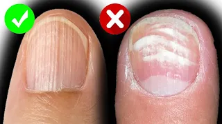 Ridges In Nails - Causes Of Nail Ridges And How To Treat Them