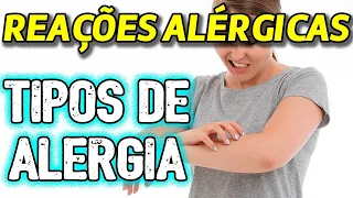 Reações Alérgicas - Diferentes tipos de alergia