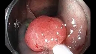 Transverse colon - Large flat lesion - LST-NG - EMR