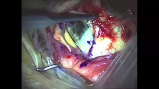 Choroidectomy and plaque brachytherapy for uveal melanoma