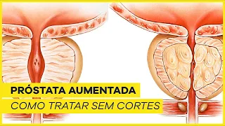 Alternativa à cirurgia convencional para tratar a PRÓSTATA aumentada