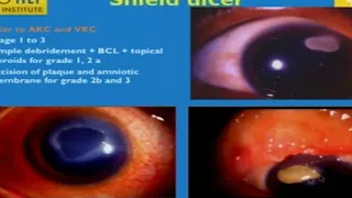 AIOC2018 - IC095 - Topic - Complications of ocular allergy and their....