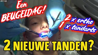 Een BEUGEL DAG! De Tandarts maakt 2 NIEUWE TANDEN? Deed dit PIJN? Dit moet je even zien  #3114A