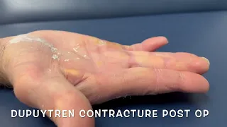 Dupuytren's disease finger contracture surgery before and after