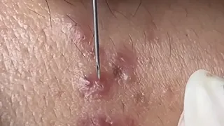 Blackheads Extraction with Hari's Beauty - 2022