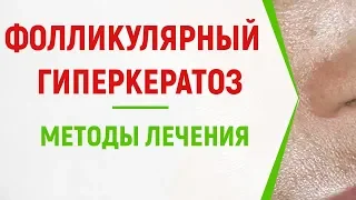 Фолликулярный гиперкератоз: ТОП методов лечения