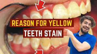 Why are my teeth yellow? I brush everyday!