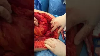 Vídeo Cirúrgico: Peritoniectomia parietal total | Dr. Arnaldo Urbano
