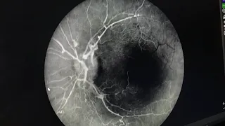 Idioptahic Retinal Vasculitis, Aneurysms & NEURORETINITIS ( IRVAN) 🥜