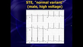 Amal Mattu’s ECG Case of the Week – February 5, 2018.TS