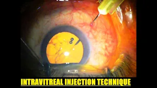 INTRAVITREAL INJECTION TECHNIQUE